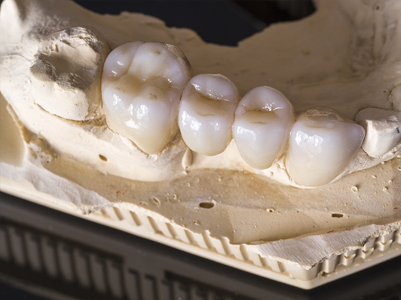 Zirconia Picture from Thomson Dental Laboratory in Tyler, TX